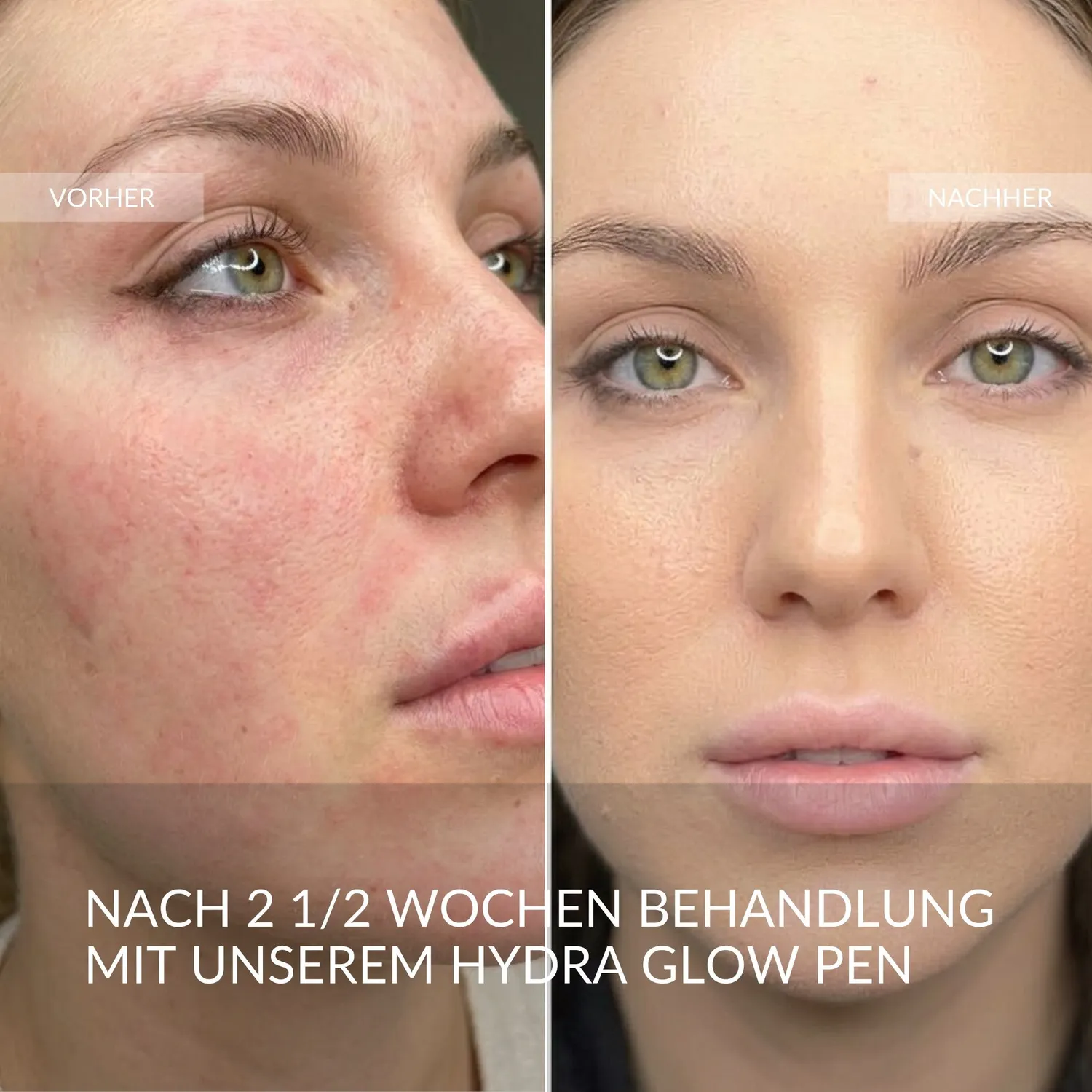 fleeky x Skinboom Hydra-Glow System Pen silber